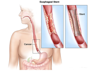 Esophagus Cancer Specialist in Delhi Ncr